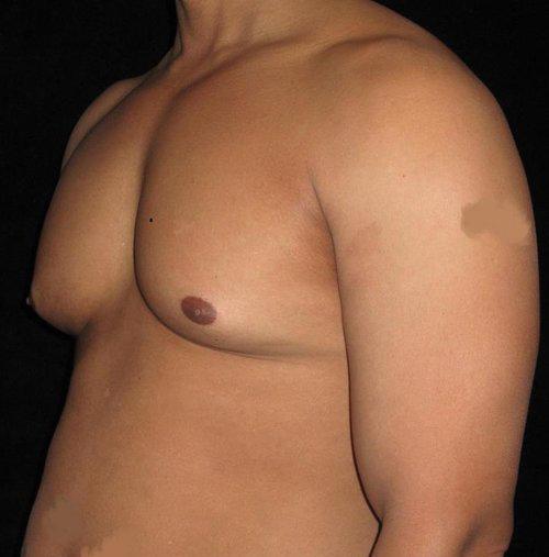 Male Breast Reduction Patient Photo - Case 30 - before view-1